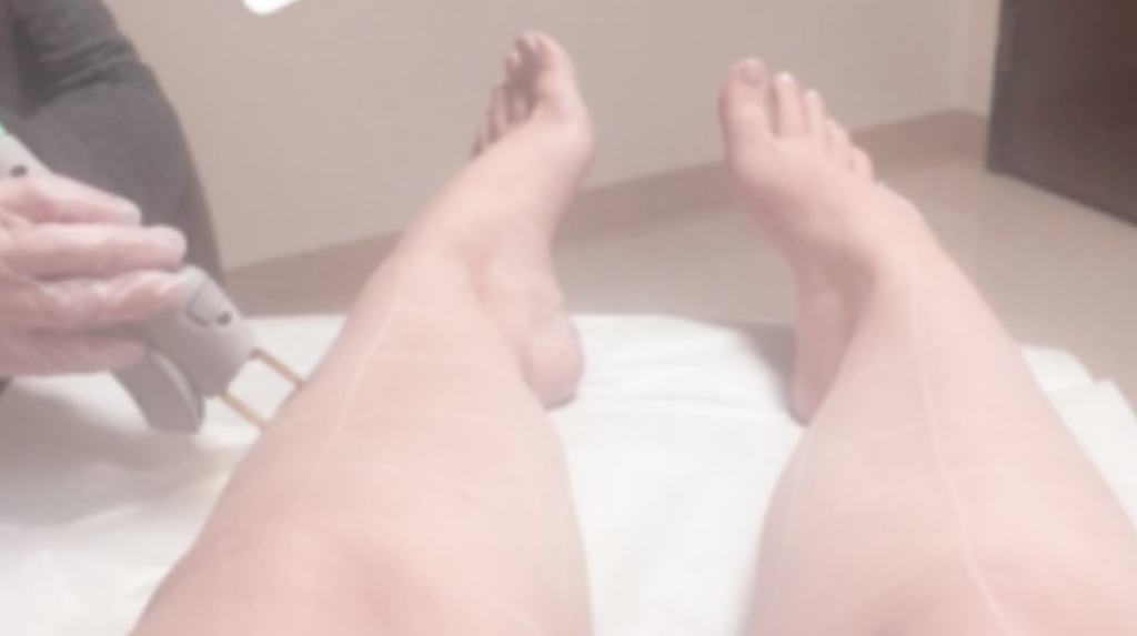 Laser Hair Removal...Is it worth it?